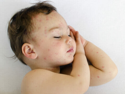 Allarme dei medici in Campania: vaccinate i bambini, si rischia epidemia di morbillo